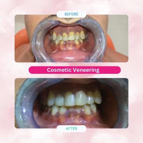Cosmetic-Veneering