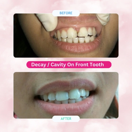 Decay-Cavity-On-Front-Tooth