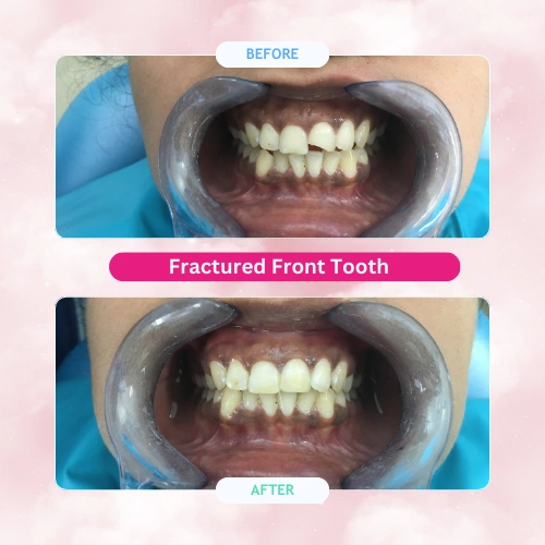 Fractured-Front-Tooth